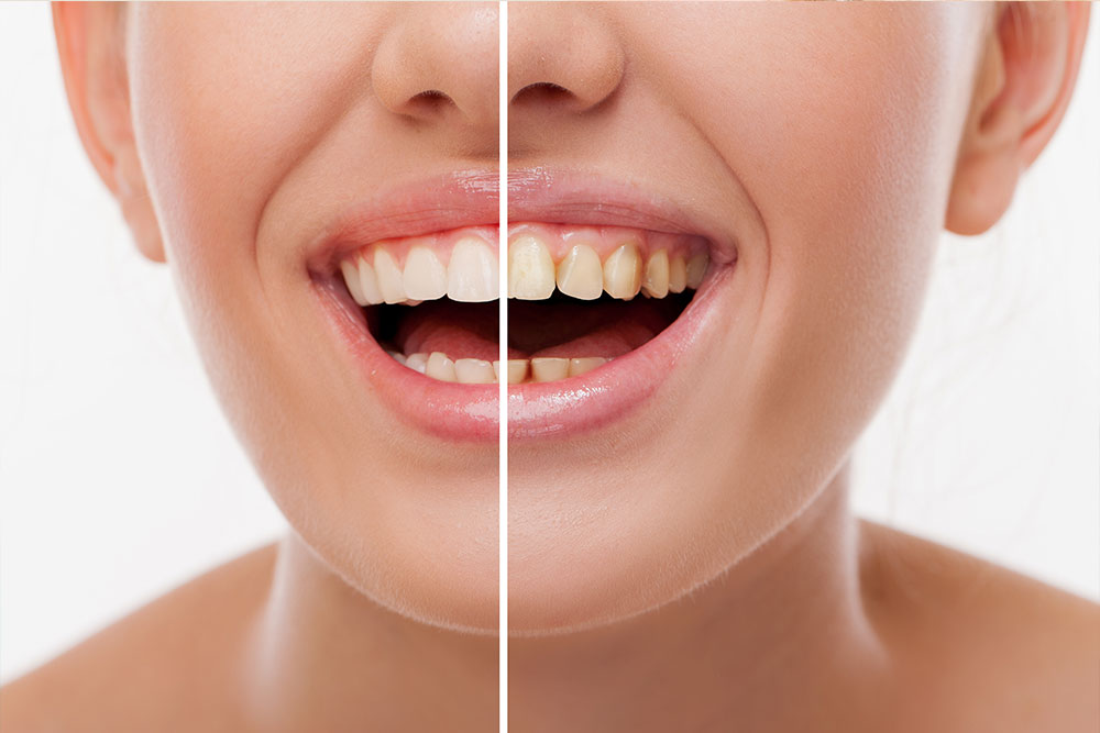 Restoratif Diş Tedavisi Nedir?